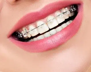 Orthodontic Treatment