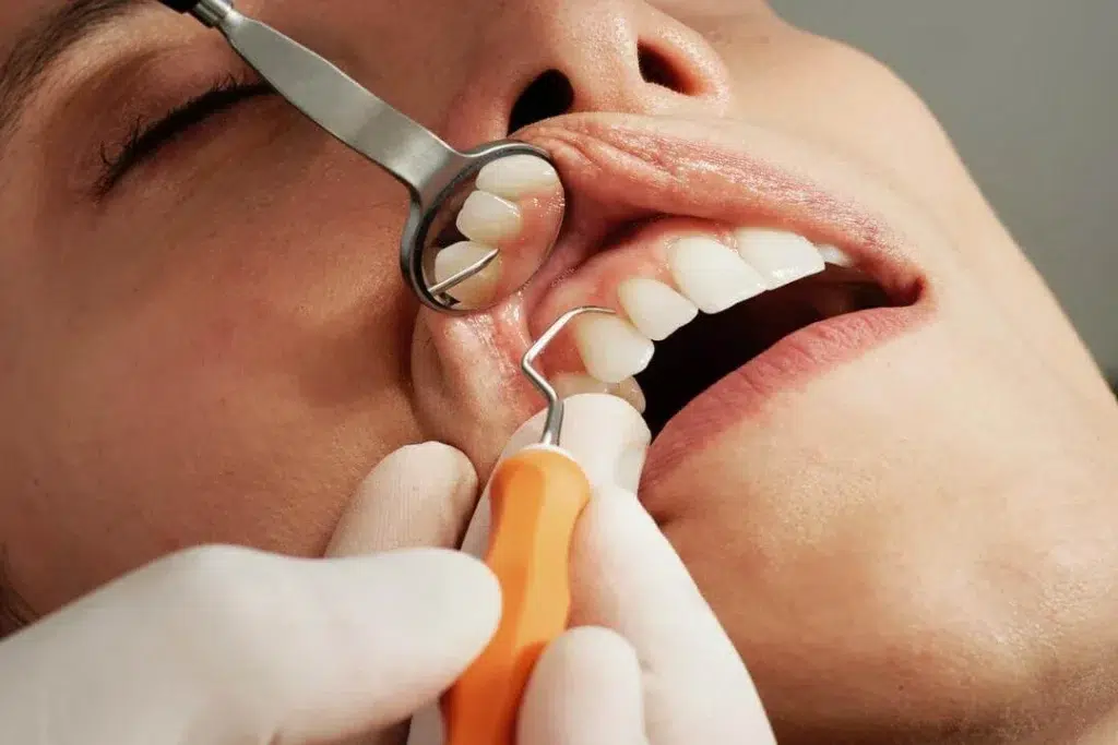 root canal treatment