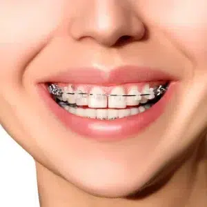 Dental Crowns & Bridges